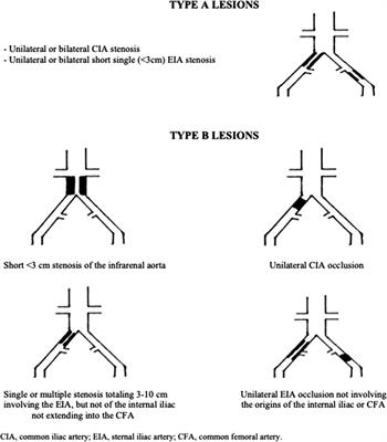 Outcomes of balloon angioplasty and stent placement for iliac artery lesions classified as TASC II A, B: a single-center study